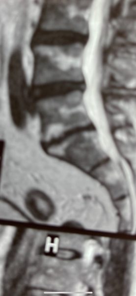 12 Month MRI