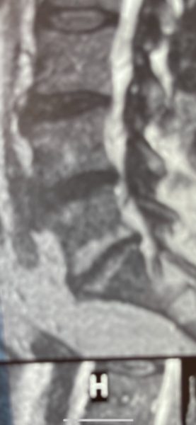 3 Month MRI